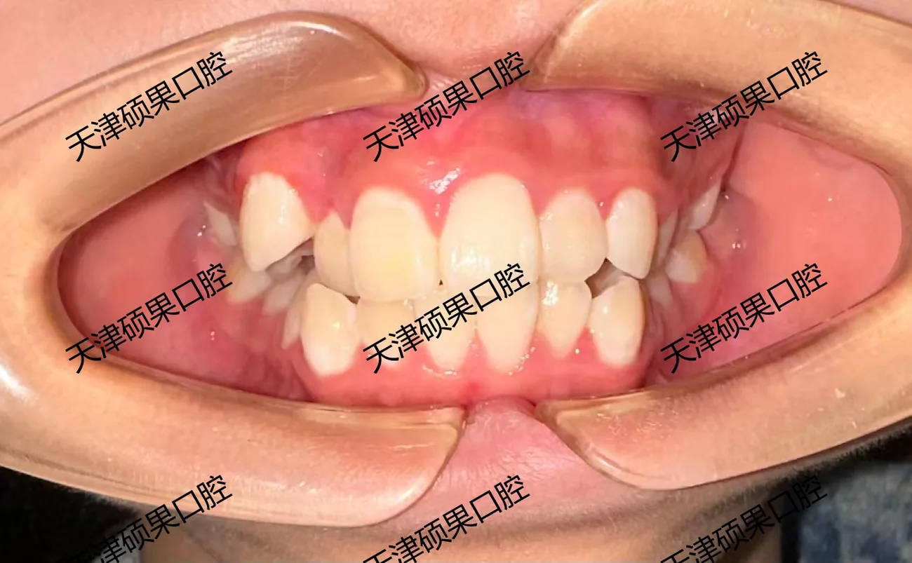 青少年牙列拥挤与前突矫正记录