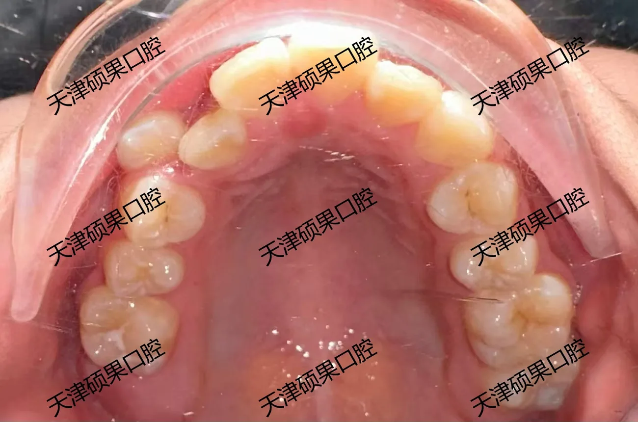 青少年牙列拥挤与前突矫正记录