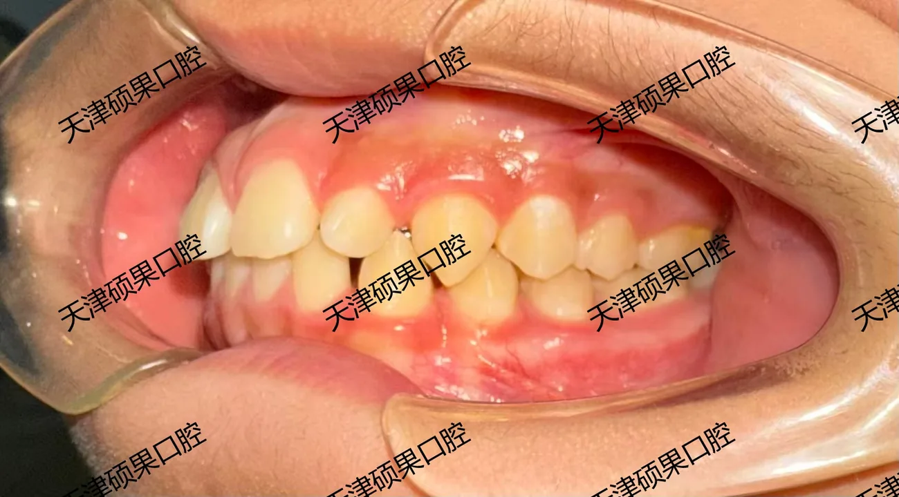 青少年前突与牙列协调矫正记录