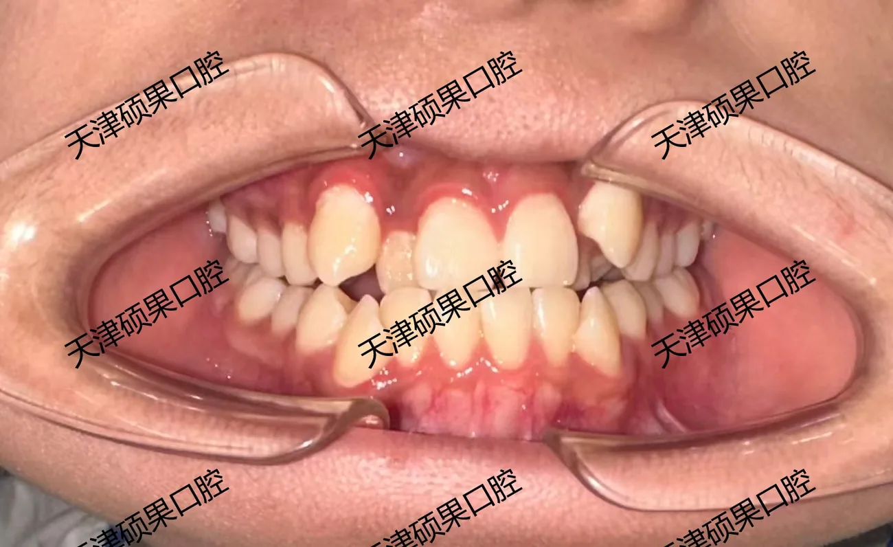 青少年前牙反合与咬合调整记录