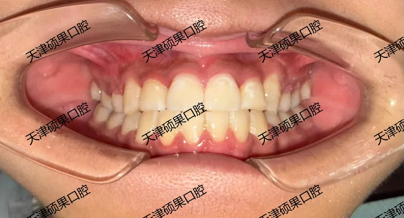 青少年前牙反合与咬合调整记录