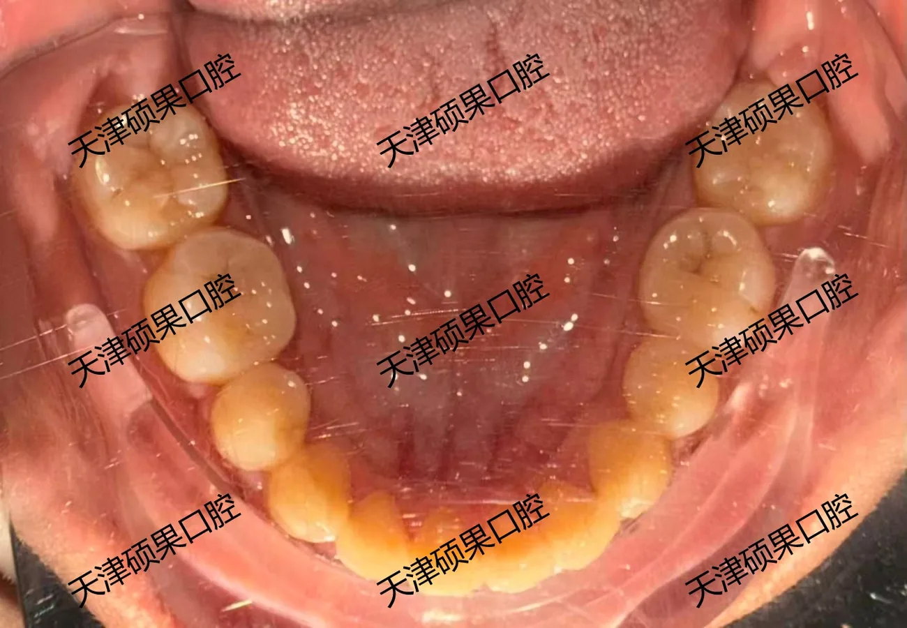 青少年前牙反合与咬合调整记录