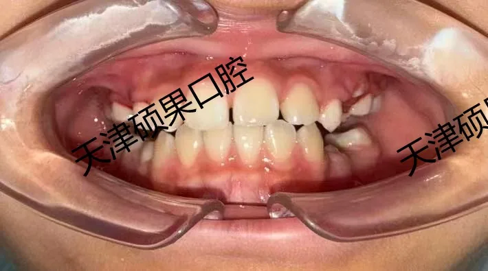 替牙期前牙反合早期干预记录