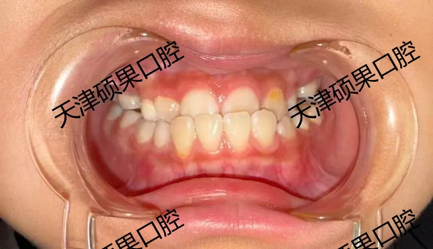 替牙期前牙反合早期干预记录