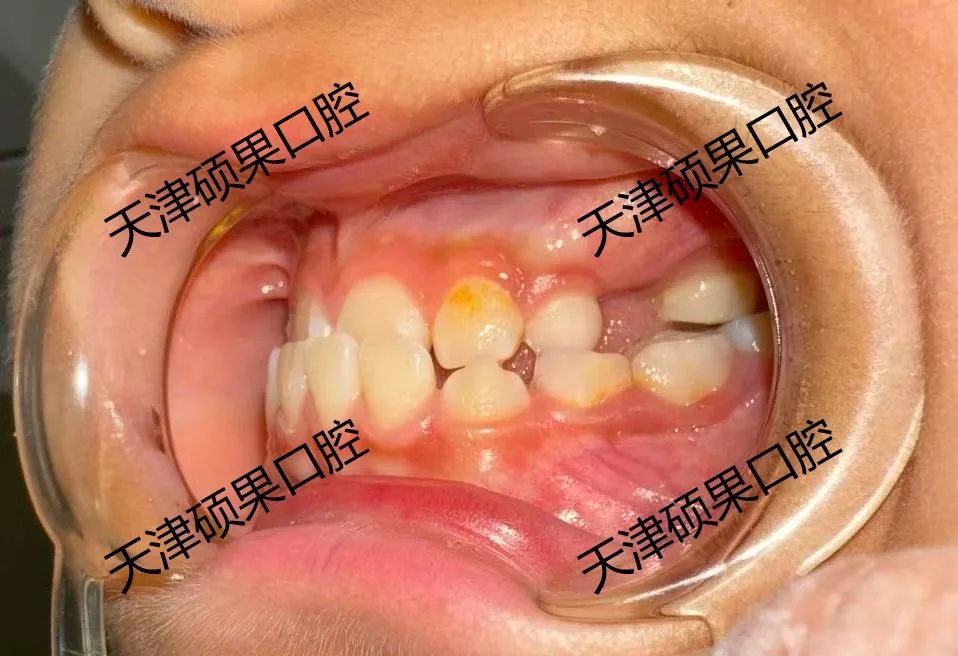 替牙期前牙反合早期干预记录